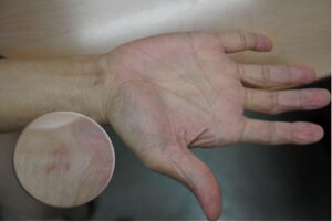 Two weeks after surgery, the wound is healed and the scar will gradually fade. Symptoms from nerve compression are fully resolved.