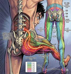 Illustration of sciatica pain areas